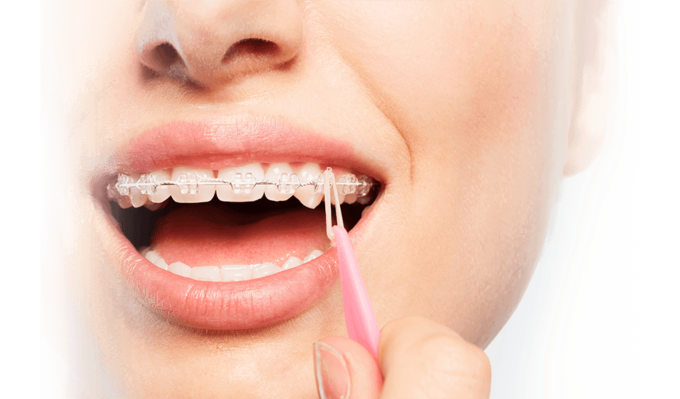 Orthodontics Australia  Elastics For Braces: Rubber Bands in